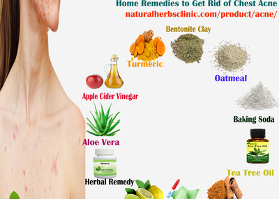 Home Remedies to Get Rid of Chest Acne